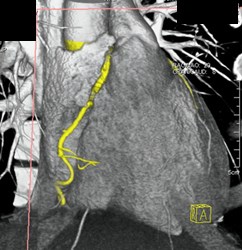 Normal RCA - CTisus CT Scan