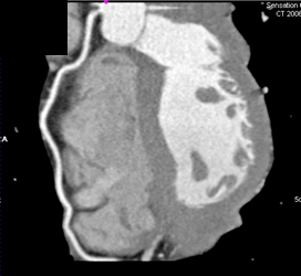 Normal RCA - CTisus CT Scan