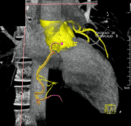 Normal RCA - CTisus CT Scan