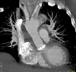 Aortic Valve Repair - CTisus CT Scan