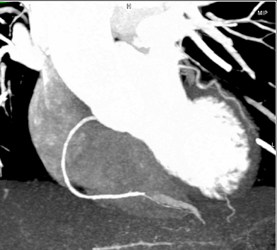 Normal RCA - CTisus CT Scan