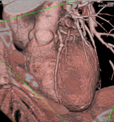 Normal LAD - CTisus CT Scan