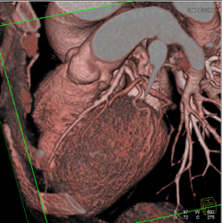 Normal LAD - CTisus CT Scan