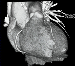 Normal RCA - CTisus CT Scan