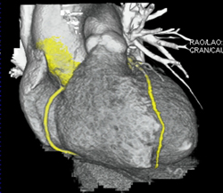 Normal RCA - CTisus CT Scan