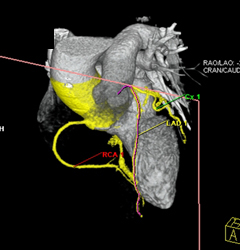 Myocardial Bridging - CTisus CT Scan