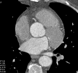 Normal RCA - CTisus CT Scan