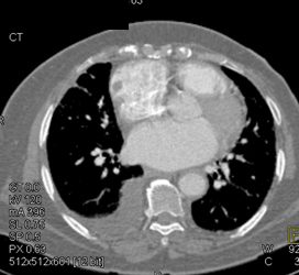 Clot in Right Ventricle - CTisus CT Scan