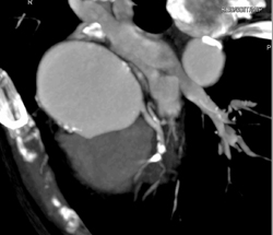 Diseased LAD - CTisus CT Scan