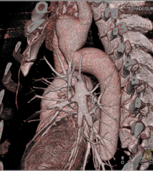 Pseudocoarctation - CTisus CT Scan