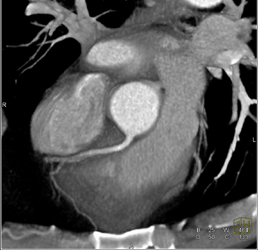 Normal LAD - CTisus CT Scan