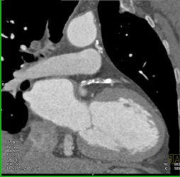 Diseased LAD - CTisus CT Scan