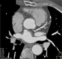 LAD Disease With Bypasses - CTisus CT Scan