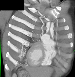 Internal Mammary Artery-look Good - CTisus CT Scan