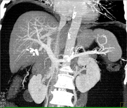 Narrow Inferior Vena Cava - CTisus CT Scan