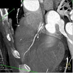 Diseased LAD - CTisus CT Scan