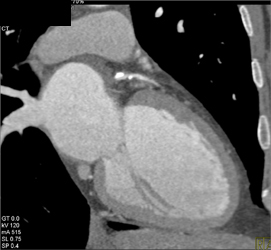 Diseased LAD - CTisus CT Scan