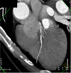 Diseased LAD - CTisus CT Scan