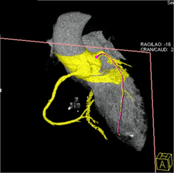 Diseased LAD - CTisus CT Scan