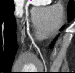 Diseased LAD - CTisus CT Scan