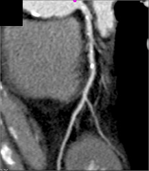 Diseased LAD - CTisus CT Scan