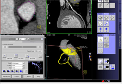 Diseased LAD - CTisus CT Scan