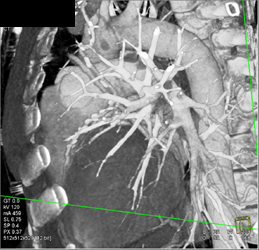 Patent Bypass Graft - CTisus CT Scan