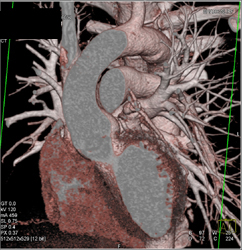 Patent Bypass Graft - CTisus CT Scan