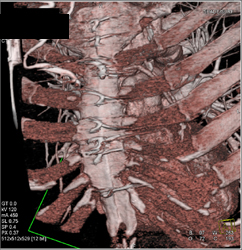 Patent Bypass Graft - CTisus CT Scan