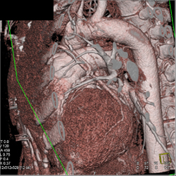 Patent Bypass Graft - CTisus CT Scan