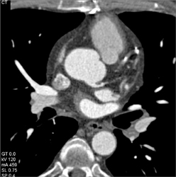 Patent Bypass Graft - CTisus CT Scan