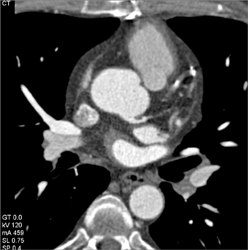 Patent Bypass Graft - CTisus CT Scan