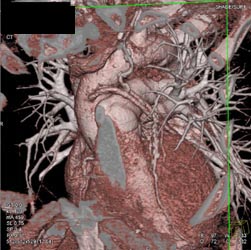 Patent Bypass Grafts But Plaque Distally-see Full Sequence - CTisus CT Scan