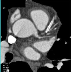 Stent in LAD - CTisus CT Scan