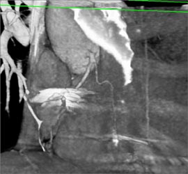 Small Circumflex Artery - CTisus CT Scan