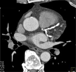 Significant Calcification of LAD and Circumflex Artery (CX) - CTisus CT Scan