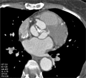 Thickened and Calcified Aortic Valve - CTisus CT Scan