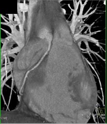 Normal RCA With Multiple Views - CTisus CT Scan