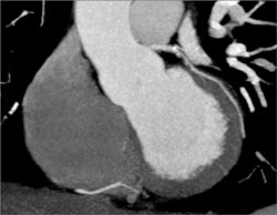 Calcified Plaque in LAD - CTisus CT Scan