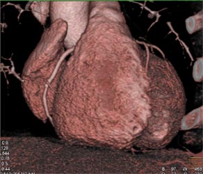 Calcified Plaque in LAD - CTisus CT Scan