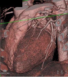 Normal Left Coronary Circulation - CTisus CT Scan