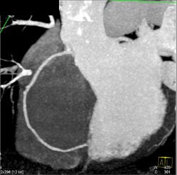 Normal RCA - CTisus CT Scan