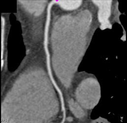 Normal RCA - CTisus CT Scan