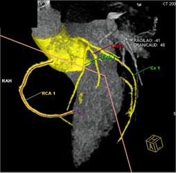 Normal RCA - CTisus CT Scan