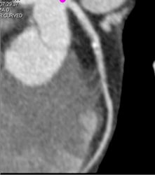 Plaque in LAD - CTisus CT Scan