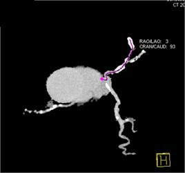 Patent Circumflex Stent - CTisus CT Scan