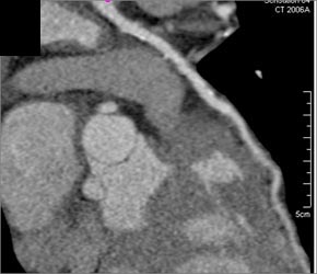 Diseased Bypass Graft - CTisus CT Scan