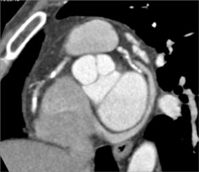 Multi-vessel Disease - CTisus CT Scan