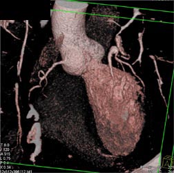 Left Main Coronary Artery Aneurysm - CTisus CT Scan