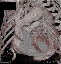 Patent Saphenous Bypass Grafts - CTisus CT Scan